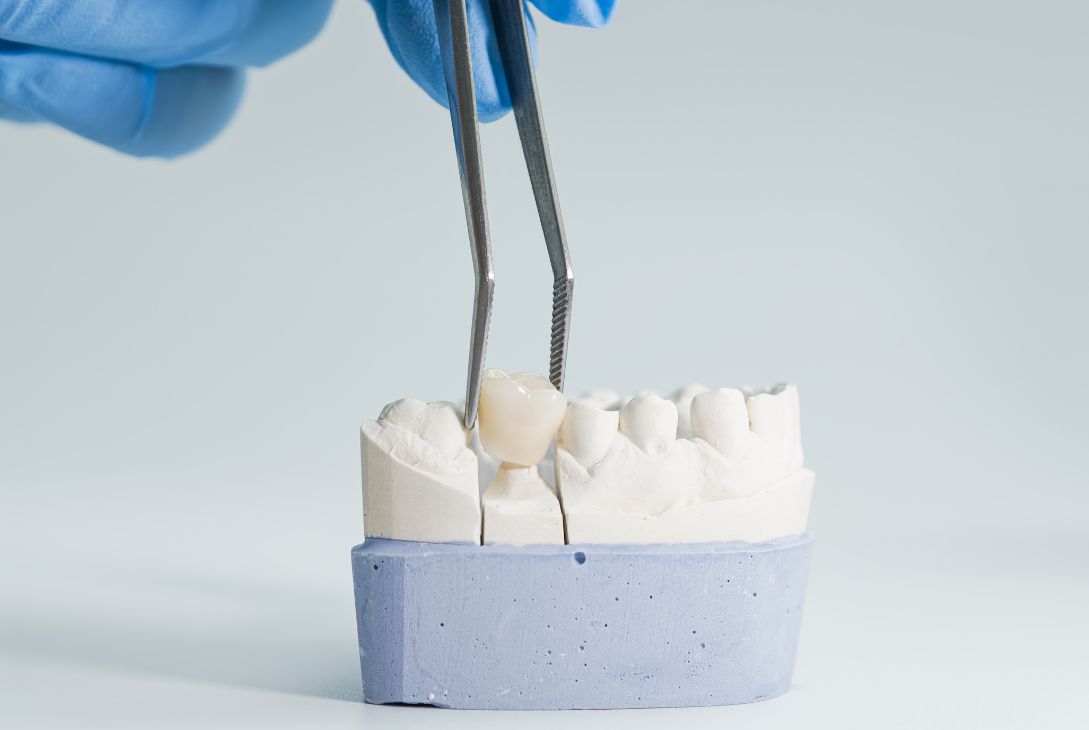CEREC Crowns