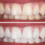 Teeth Whitening