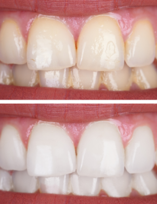 Teeth Whitening