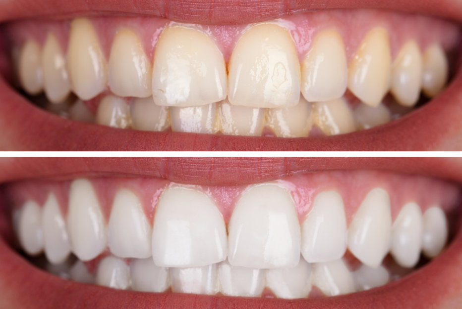 Teeth Whitening