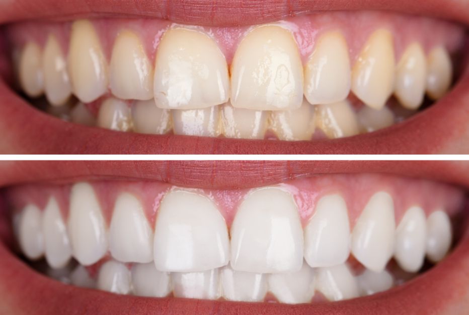 Opalescence Teeth Whitening