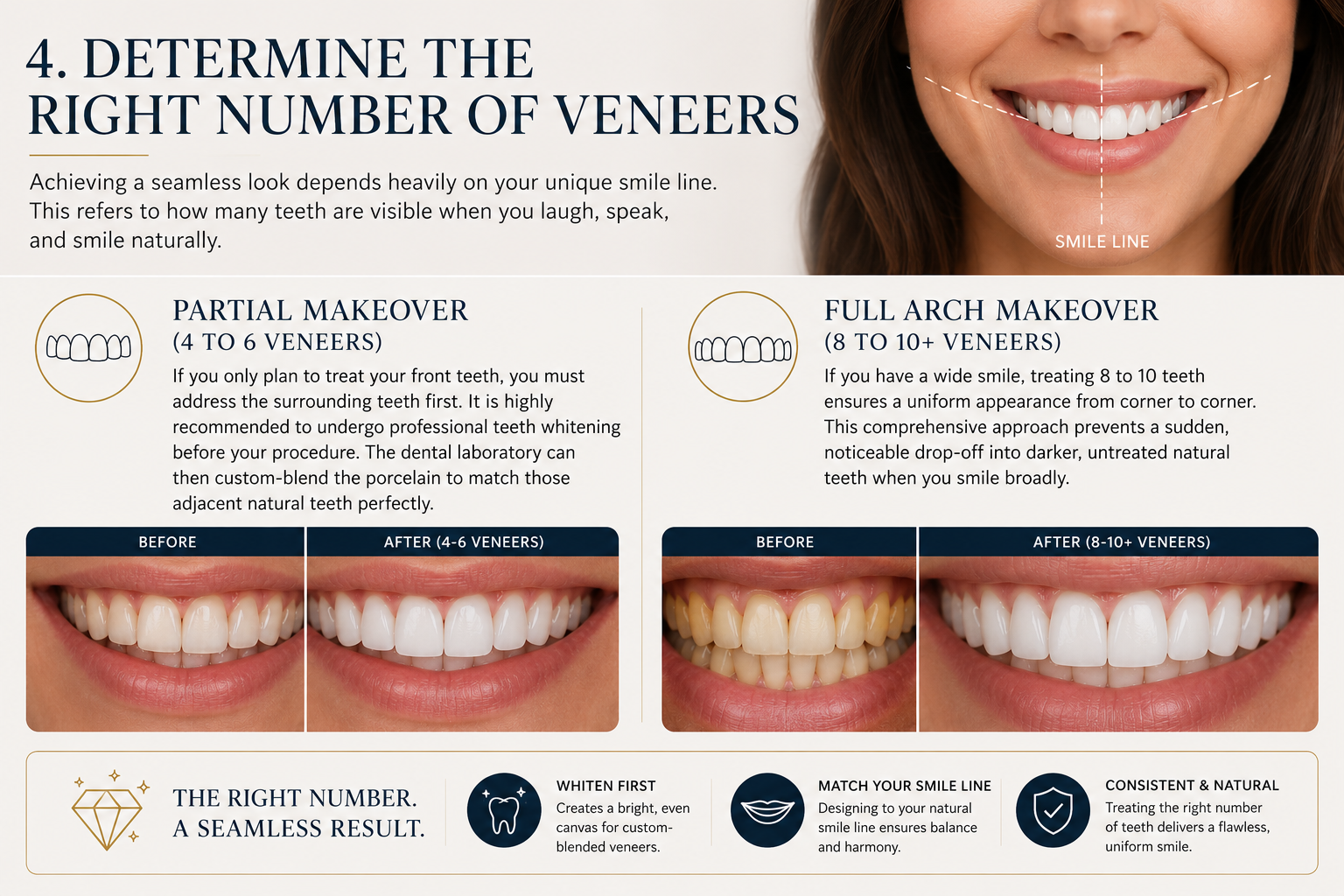 Choosing the right veneer makeover